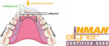 6 month smiles Stoke-on-Trent | Six month smiles Derbyshire | Inman aligner Derbyshire | Clearstep braces Stoke-on-Trent